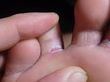 There is a fungus on the toe