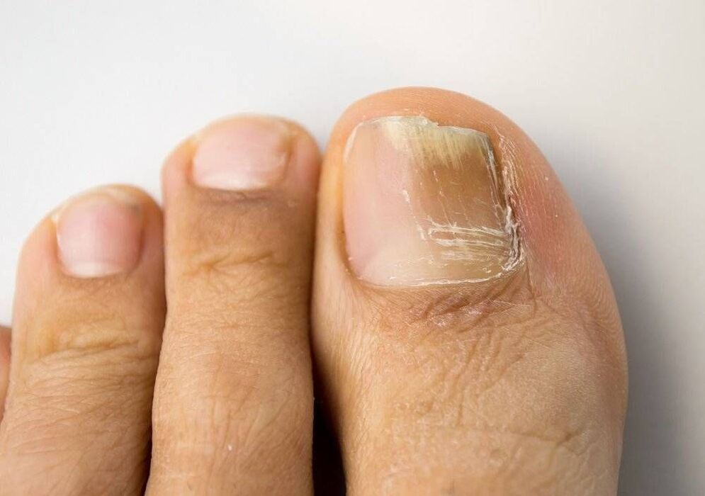 types of fungal infection on thumb