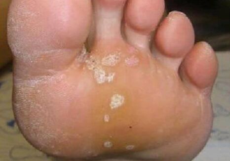 Mungal skin lesions