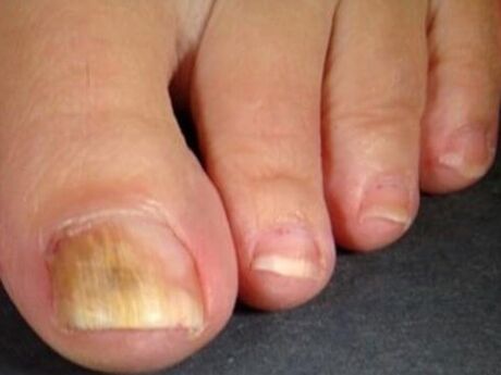 Nail trunk