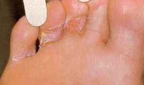 Dermaid lesions for foot mikos