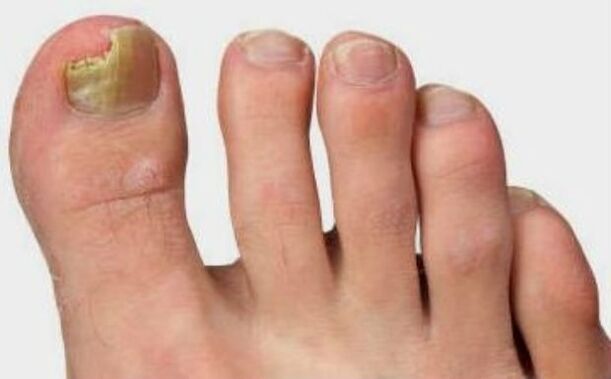 Mushrooms on the thumb of the foot