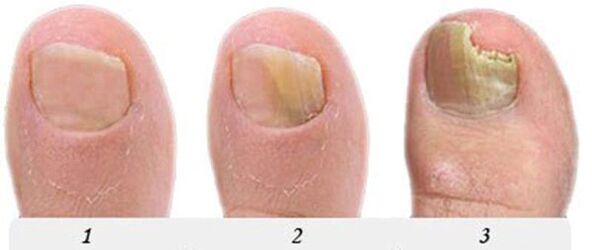 The process of developing fungi in the thumb