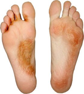 Treat the fungus on your finger and do not pick up again
