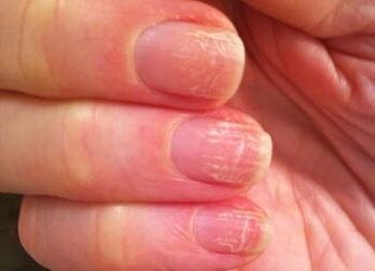 The initial stage of the mushroom in the nail