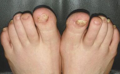 Mushroom signs in nails