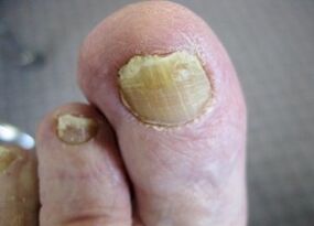 Reasons for the image of the mushroom in the nail