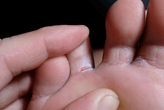 Appearance of bubbles in feet