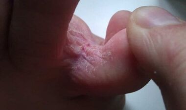 Stages of development of mushrooms between toes