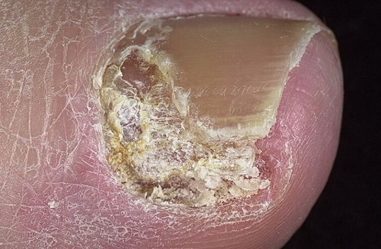 Types of onychomycosis