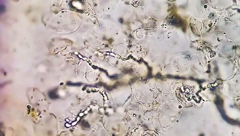 Fungi under the microscope are responsible for the development of athlete's foot